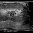 Correlative mammographic, sonographic and histopathological findings in a 29-year-old woman presenting with a palpable left axillary lump, subsequently shown to be accessory breast tissue. (a) Ultrasound, left breast, 12 o’clock position: A 10 mm partially irregular hypoechoic lesion with internal calcific foci, located 1 cm from the nipple.