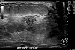 Correlative mammographic, sonographic and histopathological findings in a 29-year-old woman presenting with a palpable left axillary lump, subsequently shown to be accessory breast tissue. (a) Ultrasound, left breast, 12 o’clock position: A 10 mm partially irregular hypoechoic lesion with internal calcific foci, located 1 cm from the nipple.