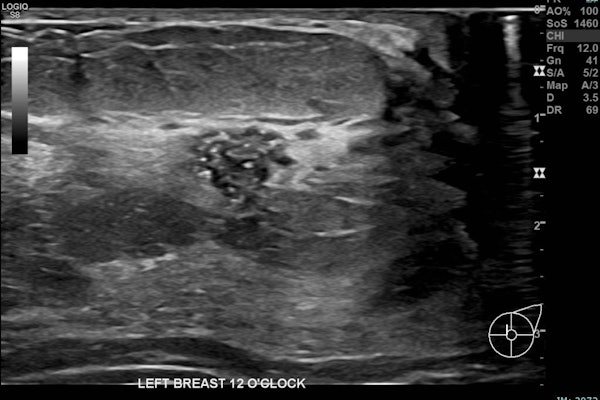 Correlative mammographic, sonographic and histopathological findings in a 29-year-old woman presenting with a palpable left axillary lump, subsequently shown to be accessory breast tissue. (a) Ultrasound, left breast, 12 o’clock position: A 10 mm partially irregular hypoechoic lesion with internal calcific foci, located 1 cm from the nipple.