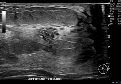 Correlative mammographic, sonographic and histopathological findings in a 29-year-old woman presenting with a palpable left axillary lump, subsequently shown to be accessory breast tissue. (a) Ultrasound, left breast, 12 o’clock position: A 10 mm partially irregular hypoechoic lesion with internal calcific foci, located 1 cm from the nipple.