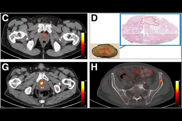 2025 11 10 Psma Pet Phase Ii Trial Thumbnail