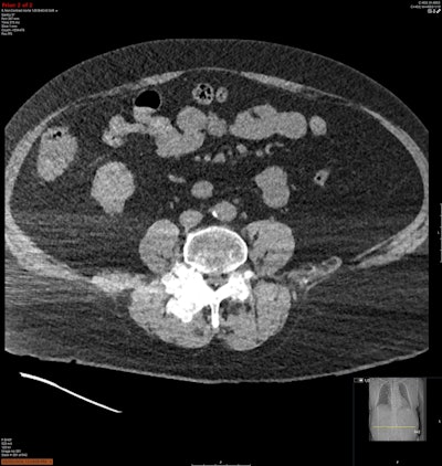 Soft tissue window of a tophus centred in the L2 lamina extending into the neural foramen.