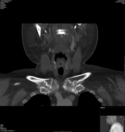Coronal bone window of the neck demonstrates destructive arthropathy of the bilateral sternoclavicular joints with surrounding partially calcified soft tissue masses in keeping with tophi.