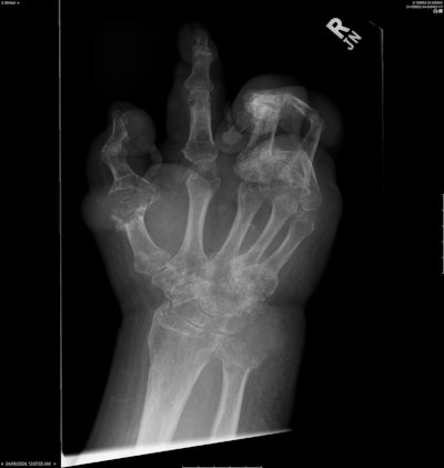 Diffuse juxta-articular erosions with overhanging edges and preserved joint spaces. Most marked at the first metatarsophalangeal joint (MTPJ) and ulnar styloid. All figures courtesy of Dr. Roland Zhang and presented at RANZCR 2025 ASM.