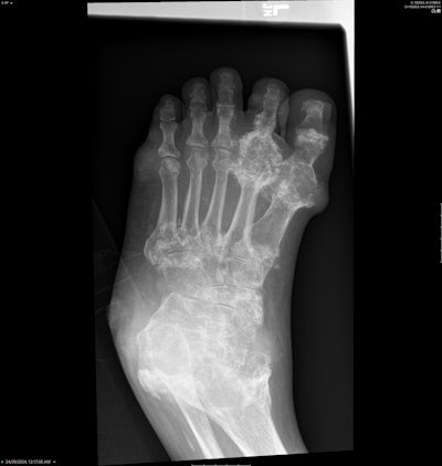 Similar findings of tophaceous gout in typical locations, such as the first MTPJ.
