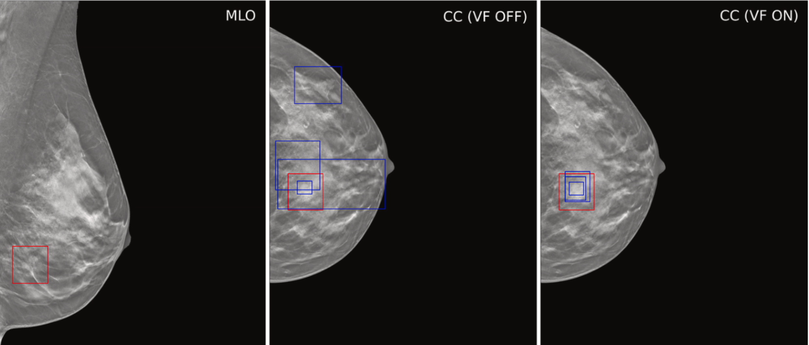 Example case demonstrating improved accuracy in lesion location with ViewFinder (VF) on versus VF off. The mediolateral oblique (MLO) view shows the source reference-standard annotation (red), while the craniocaudal (CC) images show individual radiologist annotations (blue) for both, ViewFinder ON and OFF, and the reference standard annotation (in red). Courtesy of Stephen Morrell, PhD, et al and EJR. (Note: For interpretation of the references to color in this figure legend, the reader is referred to the original version of this article.)
