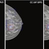 Example case demonstrating improved accuracy in lesion location with ViewFinder (VF) on versus VF off. The mediolateral oblique (MLO) view shows the source reference-standard annotation (red), while the craniocaudal (CC) images show individual radiologist annotations (blue) for both, ViewFinder ON and OFF, and the reference standard annotation (in red). Courtesy of Stephen Morrell, PhD, et al and EJR. (Note: For interpretation of the references to color in this figure legend, the reader is referred to the original version of this article.)