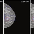 Example case demonstrating improved accuracy in lesion location with ViewFinder (VF) on versus VF off. The mediolateral oblique (MLO) view shows the source reference-standard annotation (red), while the craniocaudal (CC) images show individual radiologist annotations (blue) for both, ViewFinder ON and OFF, and the reference standard annotation (in red). Courtesy of Stephen Morrell, PhD, et al and EJR. (Note: For interpretation of the references to color in this figure legend, the reader is referred to the original version of this article.)