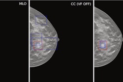 Example case demonstrating improved accuracy in lesion location with ViewFinder (VF) on versus VF off. The mediolateral oblique (MLO) view shows the source reference-standard annotation (red), while the craniocaudal (CC) images show individual radiologist annotations (blue) for both, ViewFinder ON and OFF, and the reference standard annotation (in red). Courtesy of Stephen Morrell, PhD, et al and EJR. (Note: For interpretation of the references to color in this figure legend, the reader is referred to the original version of this article.)