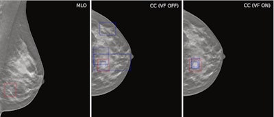 Example case demonstrating improved accuracy in lesion location with ViewFinder (VF) on versus VF off. The mediolateral oblique (MLO) view shows the source reference-standard annotation (red), while the craniocaudal (CC) images show individual radiologist annotations (blue) for both, ViewFinder ON and OFF, and the reference standard annotation (in red). Courtesy of Stephen Morrell, PhD, et al and EJR. (Note: For interpretation of the references to color in this figure legend, the reader is referred to the original version of this article.)