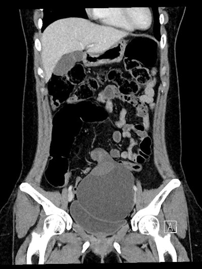 CT coronal; 25-year-old woman -- a large cystic mass in the anterior mid pelvis with smooth hyperdense borders. It converges to the right at a focal area of vascular twisting (whirlpool sign).