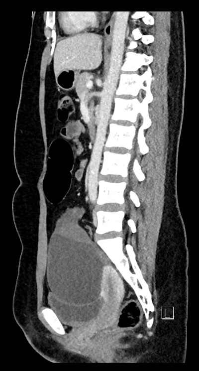 CT sagittal; 25-year-old woman -- the cystic mass is causing mass effect on the urinary bladder and uterus. The left ovary is displaced posteriorly behind the mass (not imaged on this slice).