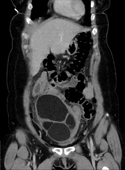 CT coronal; 37-year-old woman -- a large cystic mass in the anterior mid pelvis with smooth hyperdense borders. It converges to the right at a focal area of vascular twisting (whirlpool sign).