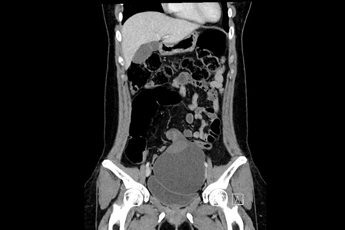 RANZCR case series reveals CT's role in identifying ovarian torsion ...