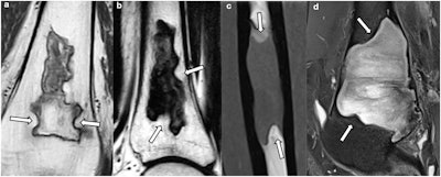 Lesions with at least two concave borders (arrows): a, b osteonecrosis; c, d fibrous dysplasia.