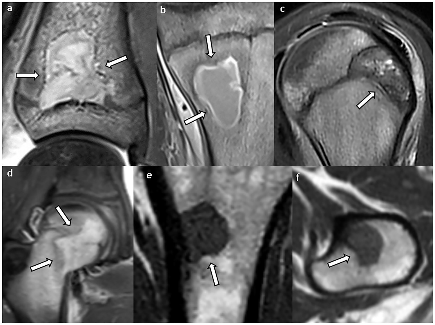 Lesions with concave borders (arrows): (a, b) intraosseous abscess, (c) chondroblastoma, (d) Langerhans cell histiocytosis, and (e, f) metastasis (same patient). In (a) and (c), one concave border follows the shape of the growth plate.