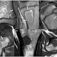 Lesions with concave borders (arrows): (a, b) intraosseous abscess, (c) chondroblastoma, (d) Langerhans cell histiocytosis, and (e, f) metastasis (same patient). In (a) and (c), one concave border follows the shape of the growth plate.