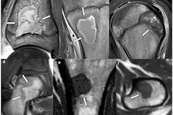 Lesions with concave borders (arrows): (a, b) intraosseous abscess, (c) chondroblastoma, (d) Langerhans cell histiocytosis, and (e, f) metastasis (same patient). In (a) and (c), one concave border follows the shape of the growth plate.