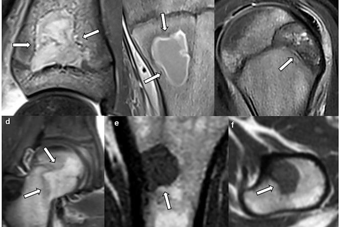 Lesions with concave borders (arrows): (a, b) intraosseous abscess, (c) chondroblastoma, (d) Langerhans cell histiocytosis, and (e, f) metastasis (same patient). In (a) and (c), one concave border follows the shape of the growth plate.