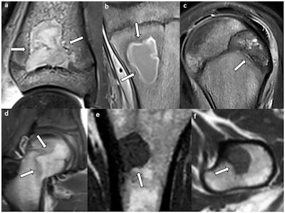 Lesions with concave borders (arrows): (a, b) intraosseous abscess, (c) chondroblastoma, (d) Langerhans cell histiocytosis, and (e, f) metastasis (same patient). In (a) and (c), one concave border follows the shape of the growth plate.