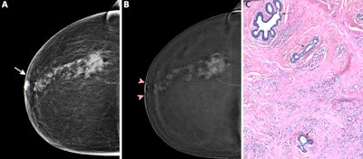 Preoperative CEM images in a 73-year-old female patient show true-positive findings of a nonluminal ERBB2-positive (formerly HER2 or HER2/neu) grade 3 invasive carcinoma of no specific type, with a spiculated mass with high conspicuity heterogeneous mass enhancement in the posterior third of the right upper outer quadrant. An area of high conspicuity clumped nonmass enhancement with associated microcalcifications (craniocaudal view of low-energy images in A; craniocaudal view of recombined images in B) extended from the mass to the nipple-areolar complex (minimum enhancement-to-nipple distance on the craniocaudal view, 0 mm), which on a (C) photomicrograph (hematoxylin-eosin stain at ×50 magnification) was completely infiltrated by malignant epithelial cells with diffuse desmoplastic stromal reaction, consistent with tumor involvement. Three residual normal ducts (arrows in C) were still present. Aside from the continuity of the nonmass enhancement with the nipple-areolar complex, other findings at CEM that were consistent with pathologic nipple involvement were the presence of an inverted nipple type and of nipple retraction (A, B), periareolar skin thickening (arrow in A), and disruption of the superficial linear enhancement (arrowheads in B).