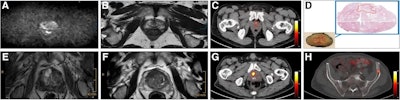 Axial views of exemplary case studies in which additional PSMA PET/CT changed prostate cancer (PCa) management. (A–D) A 68-year-old man with isolated PSA elevation had no tumor-suggestive findings on mpMRI (A and B), but they were high suggestive of PCa on PSMA-PET/CT (C). After radical prostatectomy, 22-mm index tumor identified on PSMA- PET/CT was confirmed with Gleason score of 7a (D). Reviewers without PSMA-PET/CT information (MRI-only pathway) recommended continued PCa screening, whereas reviewers with PSMA PET/CT knowledge suggested active treatment. (E–H) A 72-year-old man with PSA of 9.1 ng/mL and suggestive prostate palpation had highly suggestive PCa lesion on both mpMRI (E and F) and PSMA-PET/CT (G). PSMA-PET/CT also detected two small osseous metastases in left ilium (H) and sacrum. Management recommendations varied: local therapy (surgery or radiation) without PSMA PET/CT knowledge versus androgen deprivation therapy and radiation for primary tumor and metastases with PSMA-PET/CT knowledge.