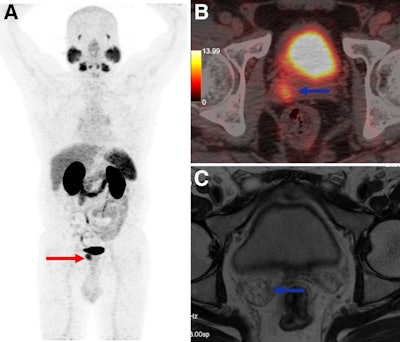 A 55-year-old man presenting for initial staging of prostate cancer. (A) Ga-68 PSMA-11 PET/CT maximum-intensity projection shows PSMA-expressing lesion involving prostate (red arrow), with PSMA avidity in right seminal vesicle invasion (blue arrow). (B) PET/CT axial image shows right seminal vesicle invasion (blue arrow). (C) However, MRI at same topography shows no seminal vesicle invasion. Pathology analysis confirmed Ga-68 PSMA-11 PET/CT-positive results.