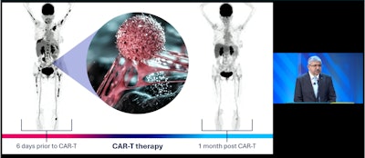 RSNA president Umar Mahmood, MD, PhD, discusses current applications and advances in molecular imaging for precision medicine, CAR-T cell therapy being one.