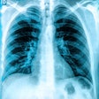 X Ray Chest Lungs