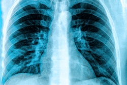 X Ray Chest Lungs