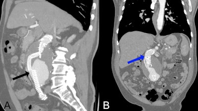 Postoperative CT angiography at presentation shows type Ia and type IIIa endoleaks. (A) Multiplanar reconstruction in a predominantly sagittal plane with maximum intensity projection (MIP) showing a type IIIA endoleak (black arrow) caused by disconnection between the limb extension and the branch of the Anaconda bifurcated endograft. (B) Multiplanar reconstruction in a mainly coronal plane with MIP demonstrating a type 1A endoleak (blue arrow) originating from the proximal seal zone and extending into the aneurysmal sac.