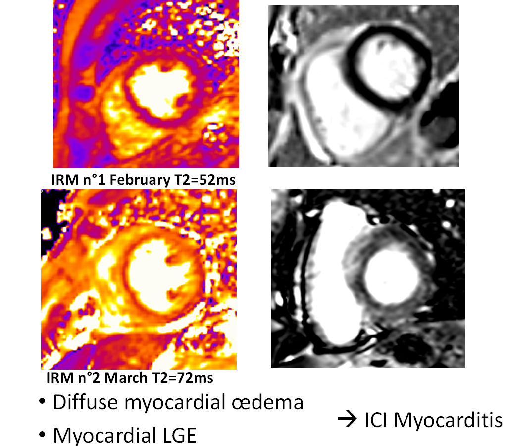 Patient with diffuse myocardial edema. Myocardial late gadolinium enhancement shows myocarditis caused by immune checkpoint inhibitors. Courtesy of Prof. Alexis Jacquier.