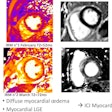 Patient with diffuse myocardial edema. Myocardial late gadolinium enhancement shows myocarditis caused by immune checkpoint inhibitors. Courtesy of Prof. Alexis Jacquier.