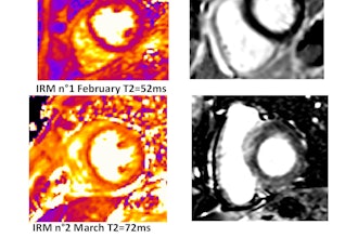Patient with diffuse myocardial edema. Myocardial late gadolinium enhancement shows myocarditis caused by immune checkpoint inhibitors. Courtesy of Prof. Alexis Jacquier.