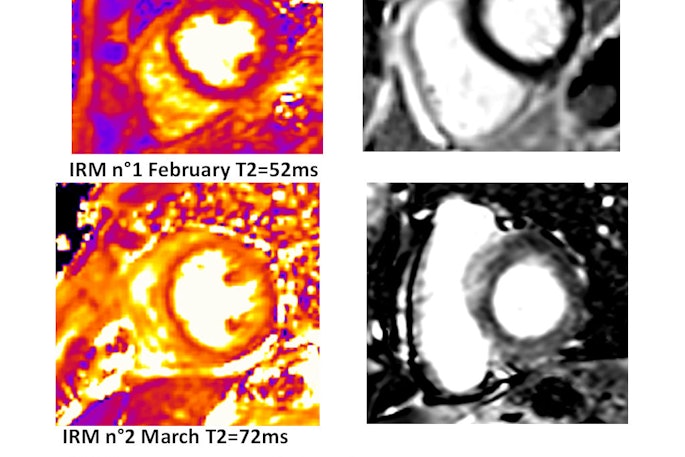 Patient with diffuse myocardial edema. Myocardial late gadolinium enhancement shows myocarditis caused by immune checkpoint inhibitors. Courtesy of Prof. Alexis Jacquier.
