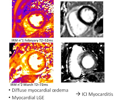 Patient with diffuse myocardial edema. Myocardial late gadolinium enhancement shows myocarditis caused by immune checkpoint inhibitors. Courtesy of Prof. Alexis Jacquier.