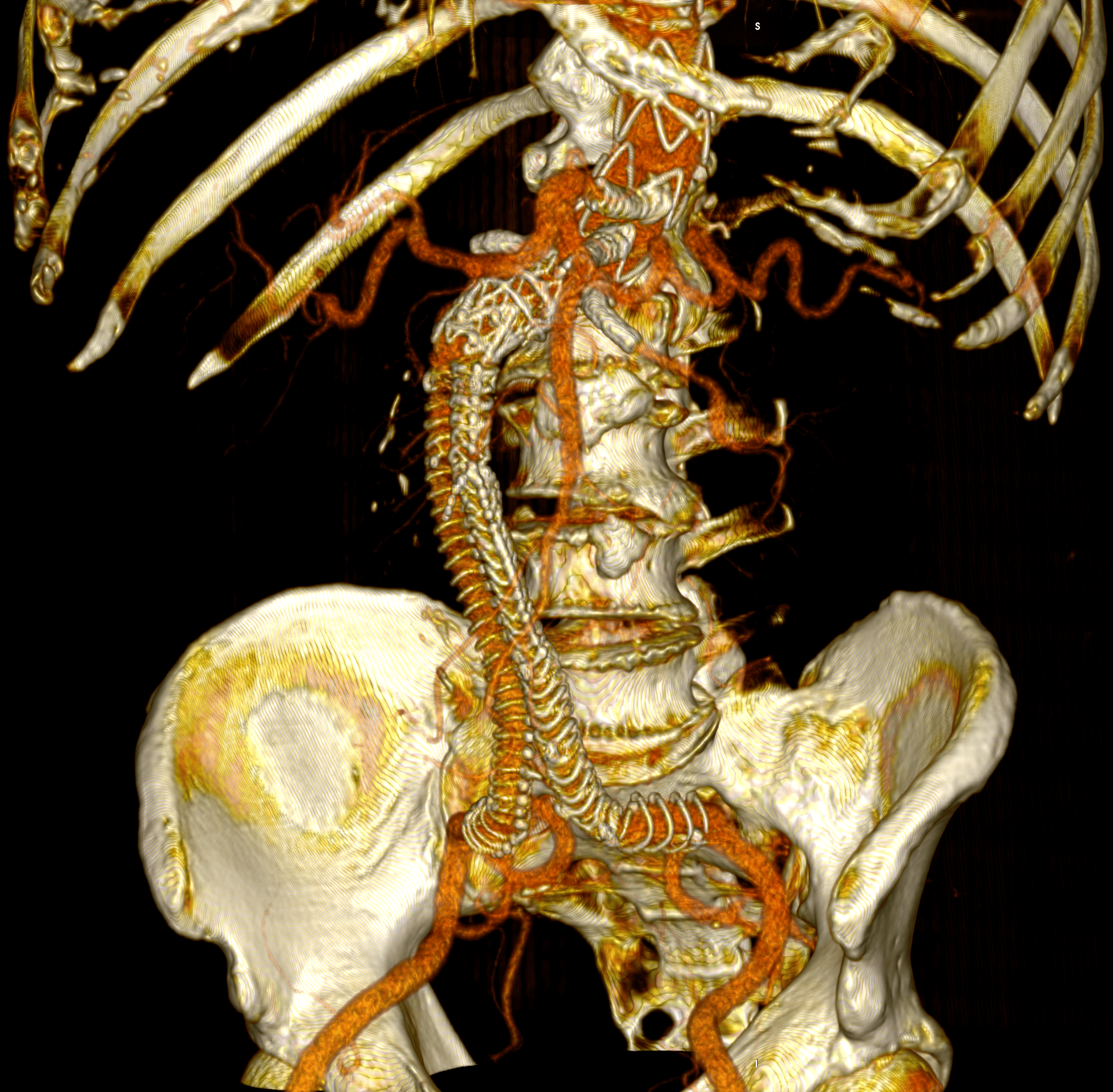 Postoperative 3D volume rendering of the fenestrated endograft reconstruction: 3D volume-rendered reconstruction obtained in Horos using the standard soft-tissue preset. The image displays the postoperative appearance of the fenestrated endograft and visceral stents, extending from the descending thoracic aorta to the iliac bifurcation, acquired during the follow-up CT angiogram one month after the procedure. The reconstruction shows patent visceral branches with well-perfused stents, absence of endoleak, and successful restoration of the previously disconnected left limb with adequate iliac perfusion.