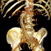 Postoperative 3D volume rendering of the fenestrated endograft reconstruction: 3D volume-rendered reconstruction obtained in Horos using the standard soft-tissue preset. The image displays the postoperative appearance of the fenestrated endograft and visceral stents, extending from the descending thoracic aorta to the iliac bifurcation, acquired during the follow-up CT angiogram one month after the procedure. The reconstruction shows patent visceral branches with well-perfused stents, absence of endoleak, and successful restoration of the previously disconnected left limb with adequate iliac perfusion.