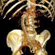 Postoperative 3D volume rendering of the fenestrated endograft reconstruction: 3D volume-rendered reconstruction obtained in Horos using the standard soft-tissue preset. The image displays the postoperative appearance of the fenestrated endograft and visceral stents, extending from the descending thoracic aorta to the iliac bifurcation, acquired during the follow-up CT angiogram one month after the procedure. The reconstruction shows patent visceral branches with well-perfused stents, absence of endoleak, and successful restoration of the previously disconnected left limb with adequate iliac perfusion.