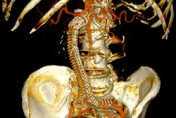 Postoperative 3D volume rendering of the fenestrated endograft reconstruction: 3D volume-rendered reconstruction obtained in Horos using the standard soft-tissue preset. The image displays the postoperative appearance of the fenestrated endograft and visceral stents, extending from the descending thoracic aorta to the iliac bifurcation, acquired during the follow-up CT angiogram one month after the procedure. The reconstruction shows patent visceral branches with well-perfused stents, absence of endoleak, and successful restoration of the previously disconnected left limb with adequate iliac perfusion.