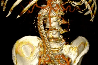 Postoperative 3D volume rendering of the fenestrated endograft reconstruction: 3D volume-rendered reconstruction obtained in Horos using the standard soft-tissue preset. The image displays the postoperative appearance of the fenestrated endograft and visceral stents, extending from the descending thoracic aorta to the iliac bifurcation, acquired during the follow-up CT angiogram one month after the procedure. The reconstruction shows patent visceral branches with well-perfused stents, absence of endoleak, and successful restoration of the previously disconnected left limb with adequate iliac perfusion.