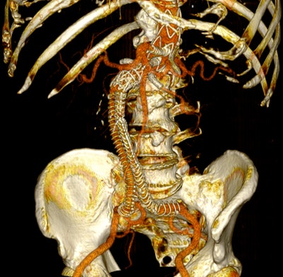 Postoperative 3D volume rendering of the fenestrated endograft reconstruction: 3D volume-rendered reconstruction obtained in Horos using the standard soft-tissue preset. The image displays the postoperative appearance of the fenestrated endograft and visceral stents, extending from the descending thoracic aorta to the iliac bifurcation, acquired during the follow-up CT angiogram one month after the procedure. The reconstruction shows patent visceral branches with well-perfused stents, absence of endoleak, and successful restoration of the previously disconnected left limb with adequate iliac perfusion.