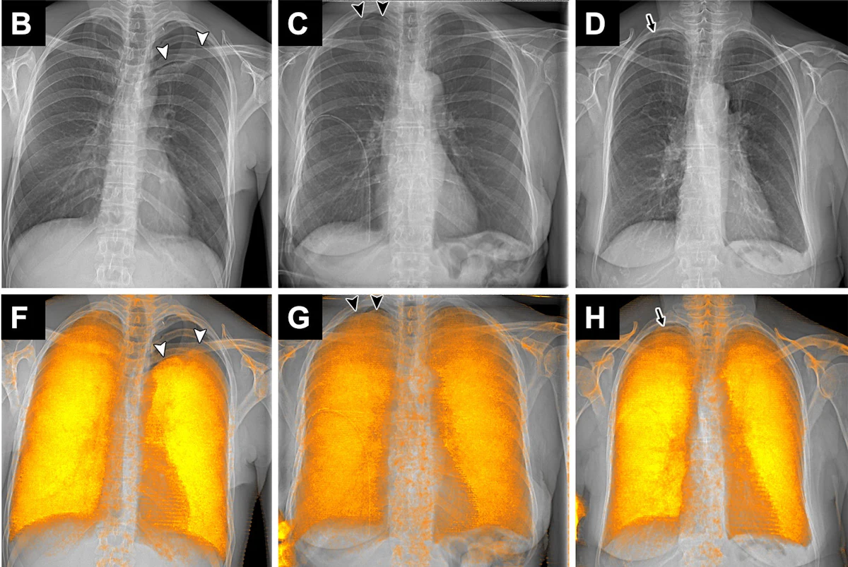 Dark-field radiography improves detection of pneumothorax ...