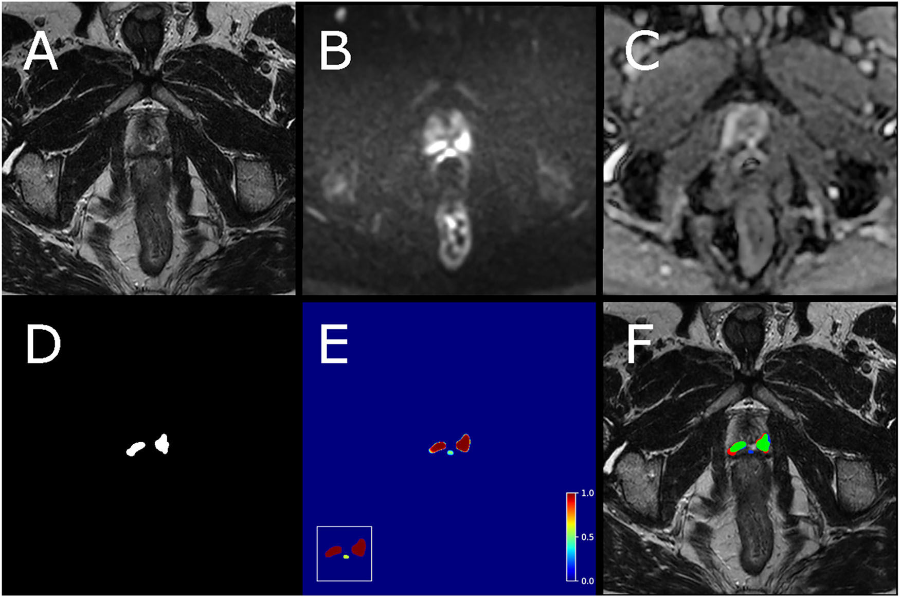 Example case from test set with biparametric MRI data, reference segmentation, and output from AI system. The primary MRI assessment resulted in a PI-RADS 5 lesion in the left dorsal part of the peripheral zone and a PI-RADS 4 lesion in the right dorsal part of the peripheral zone (PSA of 11.6 &mu;g/L). Targeted biopsies from both areas showed ISUP-grade 3. All images are from the same slice location, showing a part of both lesions. A T2-weighted (T2W) image. B Diffusion-weighted image with a b-value of 1,500 s/mm2. (C) Apparent diffusion coefficient map. (D) Reference segmentation with white areas representing tumor. (E) Softmax output from AI system. Inset in the lower left corner shows the detection map (cropped around the prostate) with red voxels representing softmax values of 0.99 and yellow voxels representing softmax values of 0.59. (F) T2W image with reference (D) and detection map (inset in E) overlayed, green represents areas in which both the reference and the AI output are positive (true positive voxels for AI), red only positive in reference (false-negative voxels for AI) and blue only segmented by AI (false-positive voxels for AI).