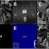 Example case from test set with biparametric MRI data, reference segmentation, and output from AI system. The primary MRI assessment resulted in a PI-RADS 5 lesion in the left dorsal part of the peripheral zone and a PI-RADS 4 lesion in the right dorsal part of the peripheral zone (PSA of 11.6 μg/L). Targeted biopsies from both areas showed ISUP-grade 3. All images are from the same slice location, showing a part of both lesions. A T2-weighted (T2W) image. B Diffusion-weighted image with a b-value of 1,500 s/mm2. (C) Apparent diffusion coefficient map. (D) Reference segmentation with white areas representing tumor. (E) Softmax output from AI system. Inset in the lower left corner shows the detection map (cropped around the prostate) with red voxels representing softmax values of 0.99 and yellow voxels representing softmax values of 0.59. (F) T2W image with reference (D) and detection map (inset in E) overlayed, green represents areas in which both the reference and the AI output are positive (true positive voxels for AI), red only positive in reference (false-negative voxels for AI) and blue only segmented by AI (false-positive voxels for AI).