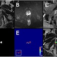 Example case from test set with biparametric MRI data, reference segmentation, and output from AI system. The primary MRI assessment resulted in a PI-RADS 5 lesion in the left dorsal part of the peripheral zone and a PI-RADS 4 lesion in the right dorsal part of the peripheral zone (PSA of 11.6 μg/L). Targeted biopsies from both areas showed ISUP-grade 3. All images are from the same slice location, showing a part of both lesions. A T2-weighted (T2W) image. B Diffusion-weighted image with a b-value of 1,500 s/mm2. (C) Apparent diffusion coefficient map. (D) Reference segmentation with white areas representing tumor. (E) Softmax output from AI system. Inset in the lower left corner shows the detection map (cropped around the prostate) with red voxels representing softmax values of 0.99 and yellow voxels representing softmax values of 0.59. (F) T2W image with reference (D) and detection map (inset in E) overlayed, green represents areas in which both the reference and the AI output are positive (true positive voxels for AI), red only positive in reference (false-negative voxels for AI) and blue only segmented by AI (false-positive voxels for AI).