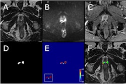 Example case from test set with biparametric MRI data, reference segmentation, and output from AI system. The primary MRI assessment resulted in a PI-RADS 5 lesion in the left dorsal part of the peripheral zone and a PI-RADS 4 lesion in the right dorsal part of the peripheral zone (PSA of 11.6 μg/L). Targeted biopsies from both areas showed ISUP-grade 3. All images are from the same slice location, showing a part of both lesions. A T2-weighted (T2W) image. B Diffusion-weighted image with a b-value of 1,500 s/mm2. (C) Apparent diffusion coefficient map. (D) Reference segmentation with white areas representing tumor. (E) Softmax output from AI system. Inset in the lower left corner shows the detection map (cropped around the prostate) with red voxels representing softmax values of 0.99 and yellow voxels representing softmax values of 0.59. (F) T2W image with reference (D) and detection map (inset in E) overlayed, green represents areas in which both the reference and the AI output are positive (true positive voxels for AI), red only positive in reference (false-negative voxels for AI) and blue only segmented by AI (false-positive voxels for AI).