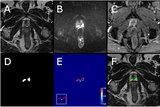 Example case from test set with biparametric MRI data, reference segmentation, and output from AI system. The primary MRI assessment resulted in a PI-RADS 5 lesion in the left dorsal part of the peripheral zone and a PI-RADS 4 lesion in the right dorsal part of the peripheral zone (PSA of 11.6 μg/L). Targeted biopsies from both areas showed ISUP-grade 3. All images are from the same slice location, showing a part of both lesions. A T2-weighted (T2W) image. B Diffusion-weighted image with a b-value of 1,500 s/mm2. (C) Apparent diffusion coefficient map. (D) Reference segmentation with white areas representing tumor. (E) Softmax output from AI system. Inset in the lower left corner shows the detection map (cropped around the prostate) with red voxels representing softmax values of 0.99 and yellow voxels representing softmax values of 0.59. (F) T2W image with reference (D) and detection map (inset in E) overlayed, green represents areas in which both the reference and the AI output are positive (true positive voxels for AI), red only positive in reference (false-negative voxels for AI) and blue only segmented by AI (false-positive voxels for AI).