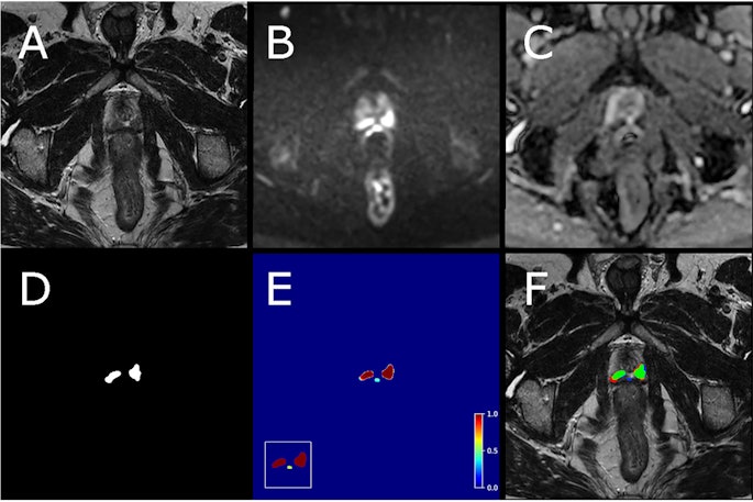Example case from test set with biparametric MRI data, reference segmentation, and output from AI system. The primary MRI assessment resulted in a PI-RADS 5 lesion in the left dorsal part of the peripheral zone and a PI-RADS 4 lesion in the right dorsal part of the peripheral zone (PSA of 11.6 μg/L). Targeted biopsies from both areas showed ISUP-grade 3. All images are from the same slice location, showing a part of both lesions. A T2-weighted (T2W) image. B Diffusion-weighted image with a b-value of 1,500 s/mm2. (C) Apparent diffusion coefficient map. (D) Reference segmentation with white areas representing tumor. (E) Softmax output from AI system. Inset in the lower left corner shows the detection map (cropped around the prostate) with red voxels representing softmax values of 0.99 and yellow voxels representing softmax values of 0.59. (F) T2W image with reference (D) and detection map (inset in E) overlayed, green represents areas in which both the reference and the AI output are positive (true positive voxels for AI), red only positive in reference (false-negative voxels for AI) and blue only segmented by AI (false-positive voxels for AI).