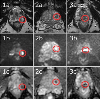 Three example cases from the test set with a negative reference (clinically significant prostate cancer not present), false-positive outputs by the AI system and true negative primary MRI assessment by radiologists. These three cases were selected to represent typical cases of false-positive AI outputs. For each case, a T2-weighted image (a), a high b-value image (b), and an apparent diffusion coefficient map (c) cropped around the prostate are shown from the same slice centered over the AI system’s output. The AI system’s findings are marked with a red circle surrounding the area instead of the segmentation, to improve visibility of the findings. Case 1. Man with prostate-specific antigen (PSA) of 3.0 ng/mL and a prostate volume of 33 mL resulting in a PSA-density of 0.09 ng/mL2. Systematic biopsies were performed and showed benign results. The AI system marked a lesion in the left apical part of the prostate. In the area, a periprostatic vein with markedly restricted diffusion can be seen. Case 2. Man with PSA of 13.6 ng/mL and a prostate volume of 91 mL resulting in a PSA-density of 0.15 ng/mL2. No biopsies were performed. The AI system marked a lesion in the left transitional zone. In the area, a well-circumscribed lesion in the transitional zone can be seen with markedly restricted diffusion. Case 3. Man with PSA of 2.3 ng/mL and a prostate volume of 30 mL resulting in a PSA-density of 0.08 ng/mL2. No biopsies were performed. The AI system marked a lesion in the middle dorsal part of the prostate. In the area, severe pile-up artifacts on the diffusion-weighted sequence caused by gas in the rectum can be seen.
